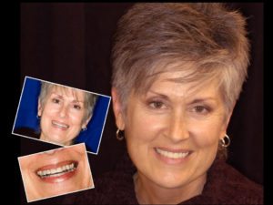Smile Makeover