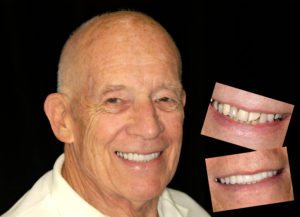 Smile Makeover Gallery, Crowns