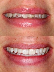 Direct Bonding, Dental Bonding