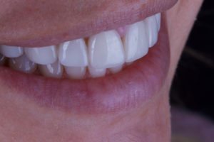 Porcelain Veneers
