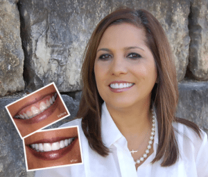 Gum Contouring