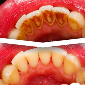 Dental Cleanings