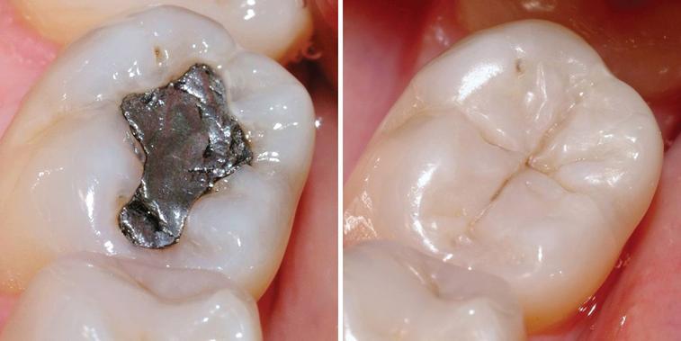 Fillings (metal free)